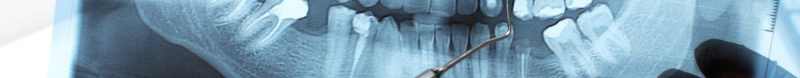 Implantes dentales