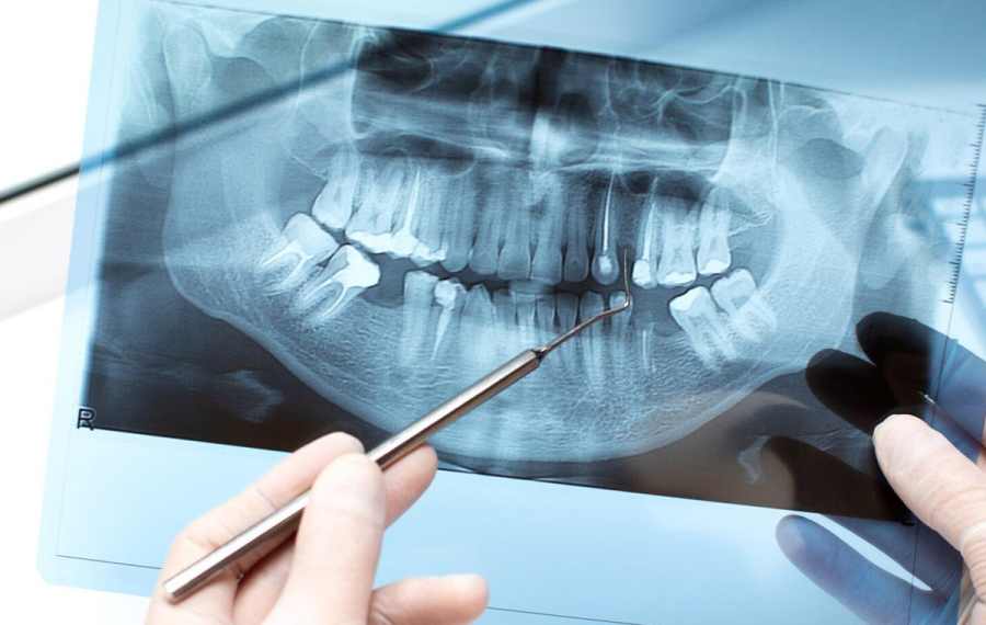 Implantes dentales